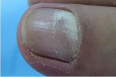 双11买指甲油，指甲油会不会导致灰指甲.灰指甲