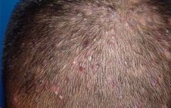 急性毛囊炎的多见症状特征